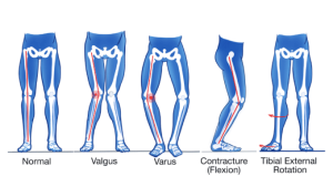 Вальгус и Варус коленных суставов. Варус вальгус тест коленного сустава.